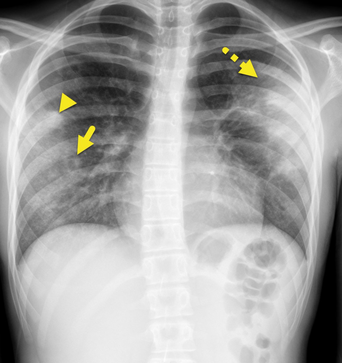 A teenager with a medical hx of autoimmune pancreatitis who had been recently weaned off steroids.

Now presented with epigastric pain, epistaxis, watery diarrhea, nonbloody emesis, weight loss, and hemoptysis. 

Thoughts?