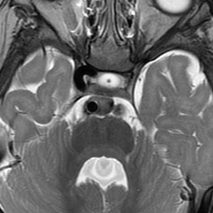jjgarnham's tweet photo. Joubert syndrome is a congenital hindbrain anomaly characterised by a vermian hypoplasia, a midline vermian cleft, thick horizontal superior cerebellar peduncles, and a dysmorphic fourth ventricular roof with loss of the normal fastigium. It's caused by mutations in genes coding for proteins involved in ciliary function (hence its classification as a ciliopathy). Additional abnormalities (e.g., polymicrogyria) are common. This patient also had a hypoplastic left internal carotid artery!