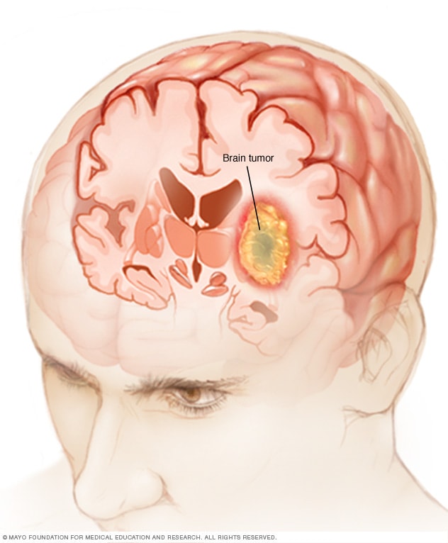 YesAlexisRwanda's tweet photo. EggGo Rwanda | Knowledge Assistant
1. What can be done to prevent brain cancer?
A) Avoid smoking and excessive alcohol consumption
B) Eat a balanced diet rich in omega-3
C) Always wear a hat when exposed to the sun
D) Avoid using a phone for long periods
#LearnMoreAbout https://t.co/cH7g8oQtap