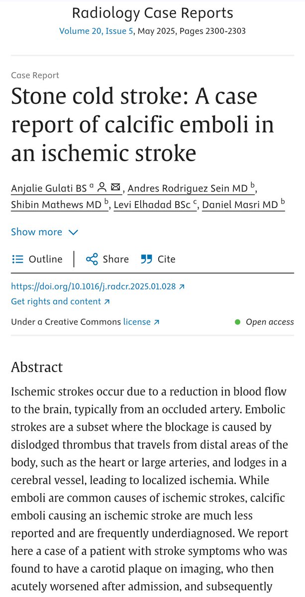 Maimonides Radiology Residency (@mmcradres) on Twitter photo 🚨 Hot off the press 🚨 New case report!
Stone cold stroke: A case report of calcific emboli in an ischemic stroke
sciencedirect.com/science/articl…
<a href="/danmasri/">Danny Masri</a> <a href="/MMCRadRes/">Maimonides Radiology Residency</a> #RadRes <a href="/sciencedirect/">Elsevier | ScienceDirect</a> 🚨 Hot off the press 🚨 New case report!
Stone cold stroke: A case report of calcific emboli in an ischemic stroke
sciencedirect.com/science/articl…
<a href="/danmasri/">Danny Masri</a> <a href="/MMCRadRes/">Maimonides Radiology Residency</a> #RadRes <a href="/sciencedirect/">Elsevier | ScienceDirect</a>