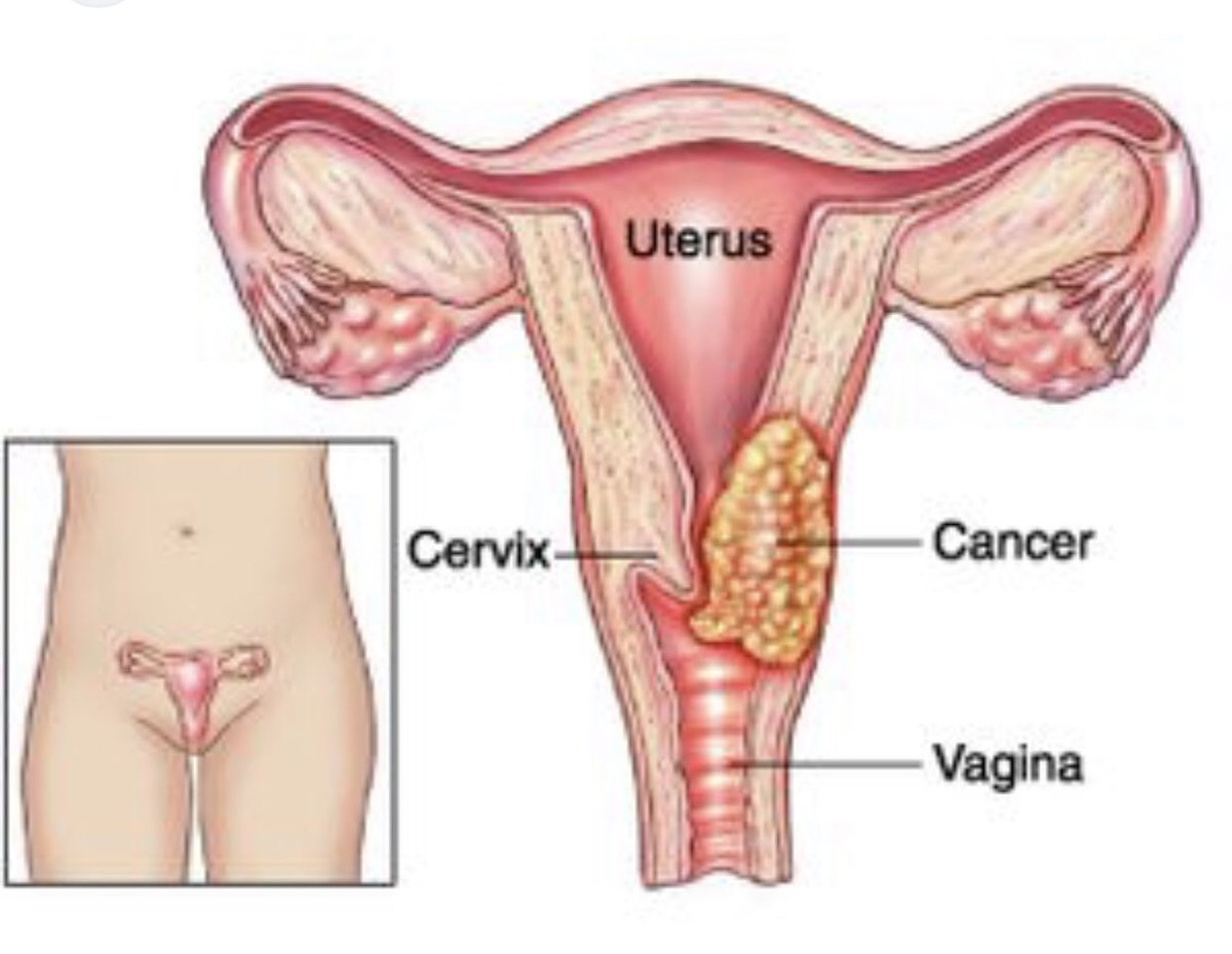 Rita Nyaaba Akologo (@akologorita) on Twitter photo Early cervical cancer screening saves lives! Get screened <a href="/CeRAB_UENR/">Centre for Research in Applied Biology</a>: Our certified Global Proficiency Testing Centre ensures reliable results with a 5-year testing interval. Book your screening today: 📞 0241764450 / 0352291734 | 📧 cerab@uenr.edu.gh Early cervical cancer screening saves lives! Get screened <a href="/CeRAB_UENR/">Centre for Research in Applied Biology</a>: Our certified Global Proficiency Testing Centre ensures reliable results with a 5-year testing interval. Book your screening today: 📞 0241764450 / 0352291734 | 📧 cerab@uenr.edu.gh