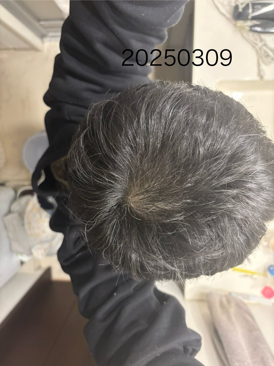 vw0917's tweet photo. AGA治療8ヶ月14日目
そんなに変化は出てこなくなった感はあるので不定期で記録しています。おでこはそこまで効果なし
高止まりしてる感じ
ただ抜け毛は増えた気がする
効きが悪くなる、薬耐性とかもあるのかもしれません。
#AGA #AGA治療
#ハゲ　#ミノフィナ通販 https://t.co/GRBuyfZ8sF