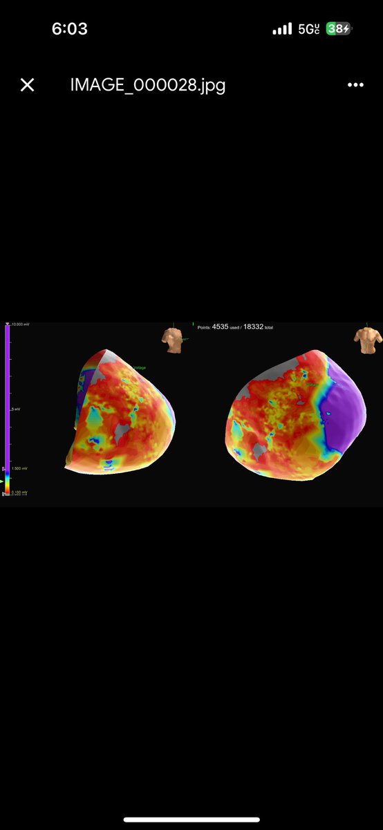 <a href="/epepps1/">epepps</a> What do you think is the diagnosis : Brugada ,ARVC, or overlap? 
46yo recurrent VT and VF, spontaneous type 2 Brugada with classic type 1 on procainamide challenge. SCN5A +. Epicardial mapping revealed extensive RV epicardial scar with no inducible VT. <a href="/VirtuaHRS/">Virtua Heart Rhythm Specialists</a>