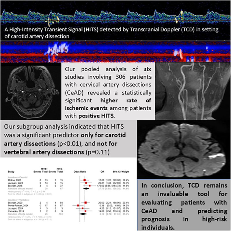 AshuJadhav (@ashupjadhav) on Twitter photo Risk Prediction of Cerebrovascular Ischemic Events Following Cervical Artery Dissections Using High‐Intensity Transient Signals: A Systematic Review, Meta‐Analysis and a Single Center Experience ahajournals.org/doi/10.1161/SV… <a href="/StrokeAHA_ASA/">Stroke AHA/ASA</a> <a href="/SVINJournal/">Stroke: Vascular and Interventional Neurology</a> <a href="/svinsociety/">SVIN</a> Risk Prediction of Cerebrovascular Ischemic Events Following Cervical Artery Dissections Using High‐Intensity Transient Signals: A Systematic Review, Meta‐Analysis and a Single Center Experience ahajournals.org/doi/10.1161/SV… <a href="/StrokeAHA_ASA/">Stroke AHA/ASA</a> <a href="/SVINJournal/">Stroke: Vascular and Interventional Neurology</a> <a href="/svinsociety/">SVIN</a>