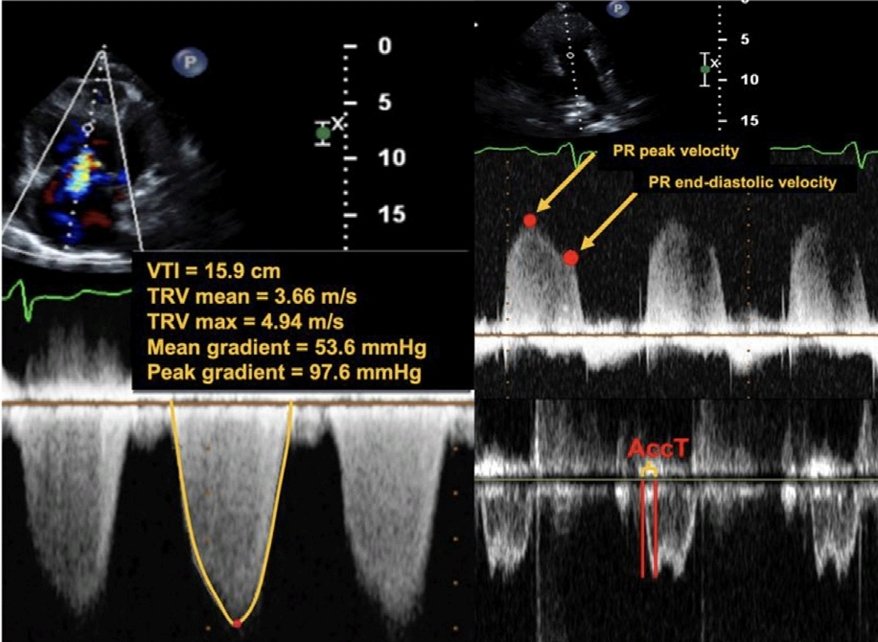 LeslieMegom's tweet photo. 🆕☝️🤓Directrices para la evaluación🫀 ecocardiográfica del corazón derecho en adultos y consideraciones especiales en hipertensión pulmonar.💥🫁
💥Recommendations from the American Society of Echocardiography 2025
👇🏽👇🏽👇🏽👇🏽
https://t.co/cfnagdOGPc
🔐
https://t.co/QjuEKBOSQ8 https://t.co/FAq7zvXkL0