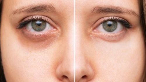 Tired of Dark Circles? Discover the Secret to Brighter Eyes! - mailchi.mp/9a18ad5d16cb/t…