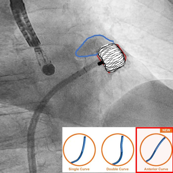PCRonline 🫀 (@pcronline) on Twitter photo Navigating LAA closure in retrobend chicken-wing anatomy
🔗 pcronline.com/Cases-resource…
View part 2⃣ of this <a href="/EUROPEANLAACC/">European LAAC Club</a> case of a 76-year-old female patient with a challenging retrobend chicken-wing morphology. Discover the strategy chosen by the team for LAA closure and Navigating LAA closure in retrobend chicken-wing anatomy
🔗 pcronline.com/Cases-resource…
View part 2⃣ of this <a href="/EUROPEANLAACC/">European LAAC Club</a> case of a 76-year-old female patient with a challenging retrobend chicken-wing morphology. Discover the strategy chosen by the team for LAA closure and
