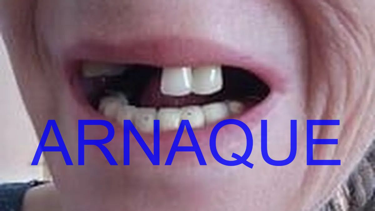 AntiArnaqueX's tweet image. 🚨 #Alerte : #Mutilations dentaires et #arnaque à grande échelle 🚨
⚠️ Des centaines de victimes des centres dentaires #Dentexia se battent pour obtenir un #procès et une #indemnisation ! 😱

🔍 Voici ce qu&apos;il faut savoir :
1️⃣ L’association &quot;La Dent Bleue&quot; a déposé une nouvelle…