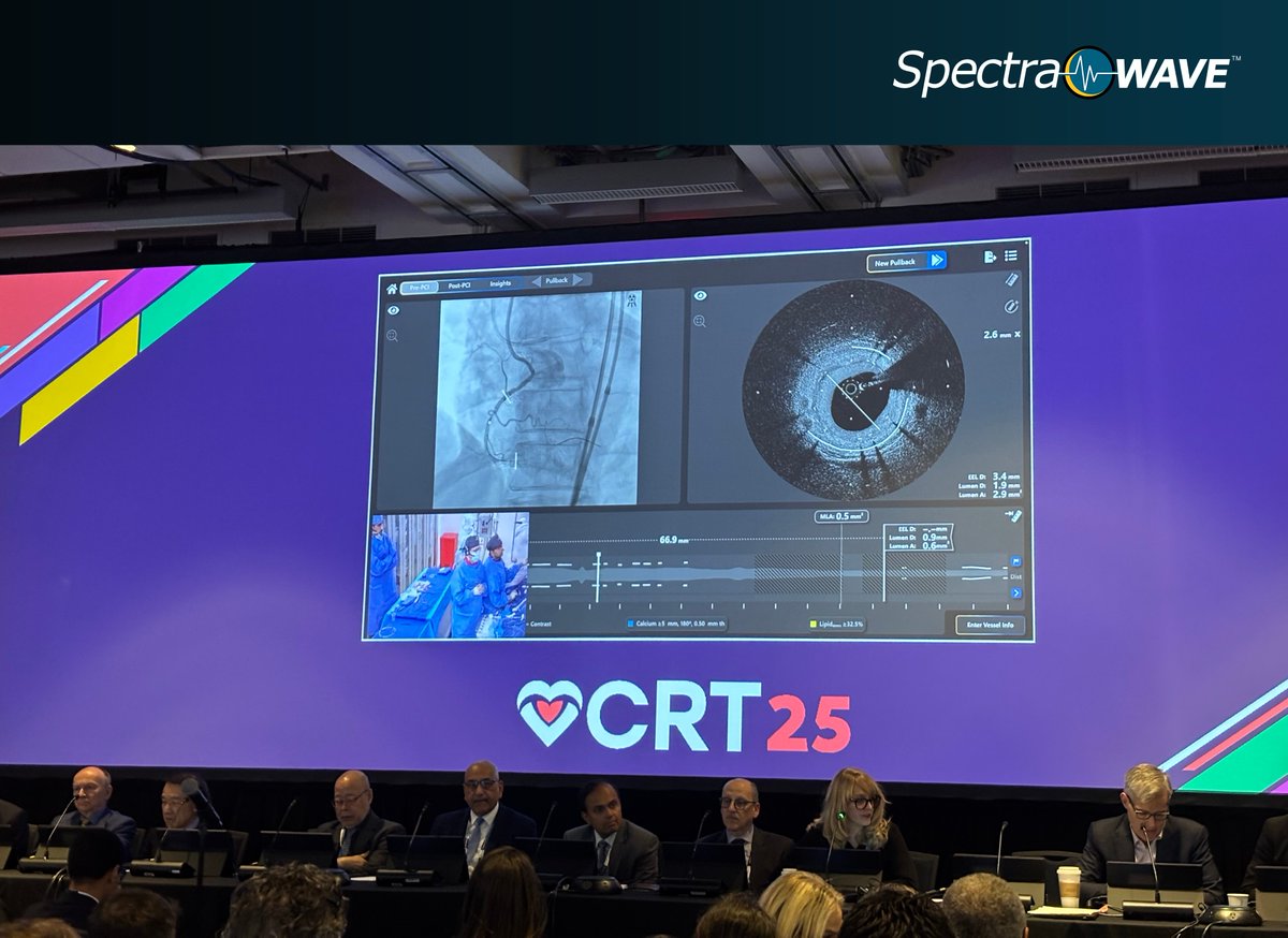 SpectraWAVE (@spectrawave_med) on Twitter photo Exciting morning on the #CRT2025 Center Stage with a live case featuring SpectraWAVE led by Dr. <a href="/RinfretStephane/">Stéphane Rinfret, MD SM</a> at Georgia Heart Institute!
Thank you to the operators and panelists for walking through a complex intra-stent CTO case and showcasing the value of the HyperVue Exciting morning on the #CRT2025 Center Stage with a live case featuring SpectraWAVE led by Dr. <a href="/RinfretStephane/">Stéphane Rinfret, MD SM</a> at Georgia Heart Institute!
Thank you to the operators and panelists for walking through a complex intra-stent CTO case and showcasing the value of the HyperVue