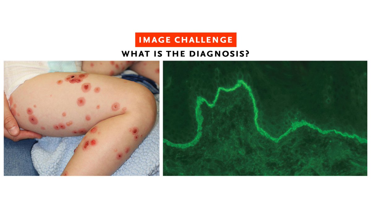 A previously healthy 2-year-old boy was brought to clinic with a 1-week history of itchy, red spots. Three days before the onset of the rash, the child had had an upper respiratory infection for which he had been given ibuprofen. Read the full case details and submit your answer