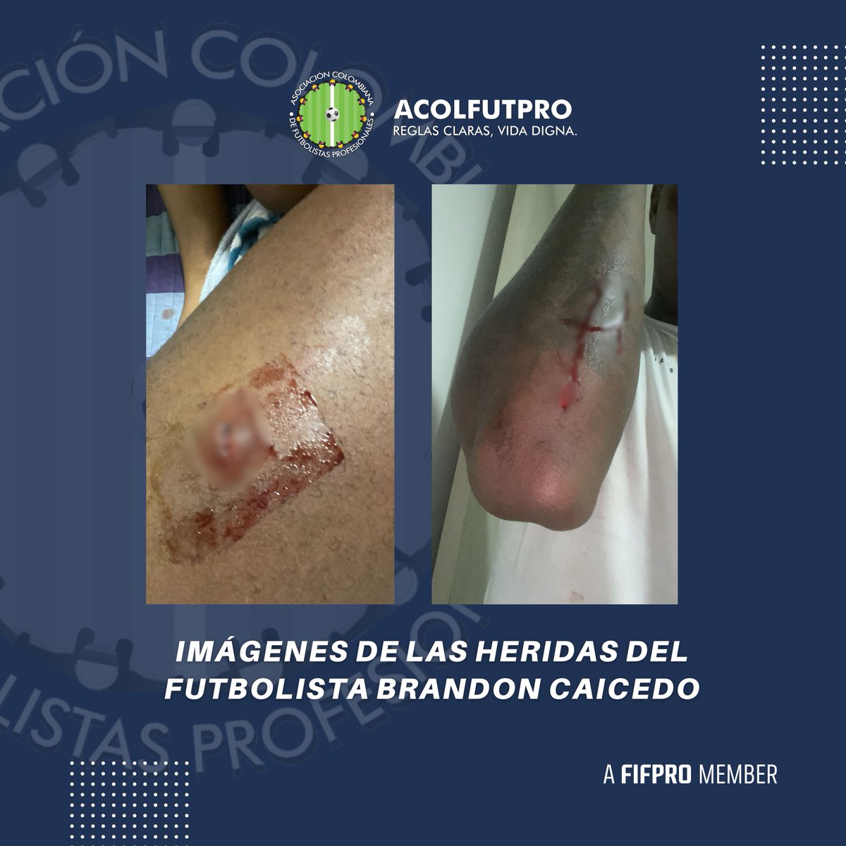 ACOLFUTPRO (@acolfutpro) on Twitter photo 𝗖𝗢𝗠𝗨𝗡𝗜𝗖𝗔𝗗𝗢 | ¡Basta ya! Violentos atentan contra la vida de un futbolista del <a href="/QuindioOficial/">Deportes Quindío S.A</a>
➡ acolfutpro.org/?p=11314
<a href="/FIFPRO/">FIFPRO</a> <a href="/FIFProAmerica/">FIFPRO Sudamérica</a> <a href="/Dimayor/">DIMAYOR</a> <a href="/FCF_Oficial/">FCF</a> <a href="/PoliciaColombia/">Policía de Colombia</a> <a href="/AlcaldiaArmenia/">Alcaldía de Armenia</a> <a href="/MinInterior/">MinInterior Colombia</a> <a href="/GabrielRondonO/">Gabriel Rondón</a> <a href="/MintrabajoCol/">MinTrabajo</a> <a href="/AntonioSanguino/">Antonio Sanguino</a> 𝗖𝗢𝗠𝗨𝗡𝗜𝗖𝗔𝗗𝗢 | ¡Basta ya! Violentos atentan contra la vida de un futbolista del <a href="/QuindioOficial/">Deportes Quindío S.A</a>
➡ acolfutpro.org/?p=11314
<a href="/FIFPRO/">FIFPRO</a> <a href="/FIFProAmerica/">FIFPRO Sudamérica</a> <a href="/Dimayor/">DIMAYOR</a> <a href="/FCF_Oficial/">FCF</a> <a href="/PoliciaColombia/">Policía de Colombia</a> <a href="/AlcaldiaArmenia/">Alcaldía de Armenia</a> <a href="/MinInterior/">MinInterior Colombia</a> <a href="/GabrielRondonO/">Gabriel Rondón</a> <a href="/MintrabajoCol/">MinTrabajo</a> <a href="/AntonioSanguino/">Antonio Sanguino</a>