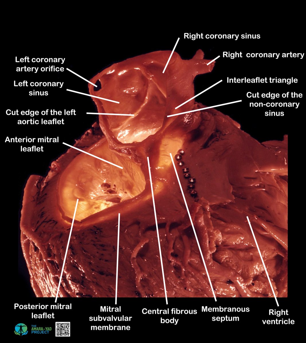 JACC Journals (@jaccjournals) on Twitter photo This week's Amara Yad image, published in #JACC, shows the attachments of the aortic root, the aortic valve and its relationship to the fibrous skeleton of the heart, the mitral valve, and the membranous septum jacc.org/doi/10.1016/j.… <a href="/shivkumarmd/">Kalyanam Shivkumar MD PhD</a> #TAVR This week's Amara Yad image, published in #JACC, shows the attachments of the aortic root, the aortic valve and its relationship to the fibrous skeleton of the heart, the mitral valve, and the membranous septum jacc.org/doi/10.1016/j.… <a href="/shivkumarmd/">Kalyanam Shivkumar MD PhD</a> #TAVR