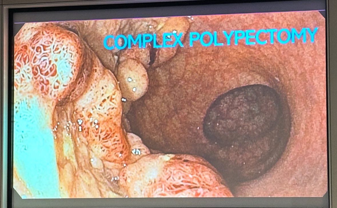 Mohammad Bilal, MD (@bilalmohammadmd) on Twitter photo Polyps dont stand a chance ✂️✂️
Incredible <a href="/ASGEendoscopy/">ASGE GI Endoscopy</a> Colon EMR ⭐️ Course !
Totally impressed by the participants & their passion and committment to advancing their skills 🔥🥶💧 #EMR
Inspired by the amazing co-faculty !
Kudos to <a href="/MdWaschke/">Kevin Waschke MD</a> & #AdamTempleton for 🔥 course Polyps dont stand a chance ✂️✂️
Incredible <a href="/ASGEendoscopy/">ASGE GI Endoscopy</a> Colon EMR ⭐️ Course !
Totally impressed by the participants & their passion and committment to advancing their skills 🔥🥶💧 #EMR
Inspired by the amazing co-faculty !
Kudos to <a href="/MdWaschke/">Kevin Waschke MD</a> & #AdamTempleton for 🔥 course