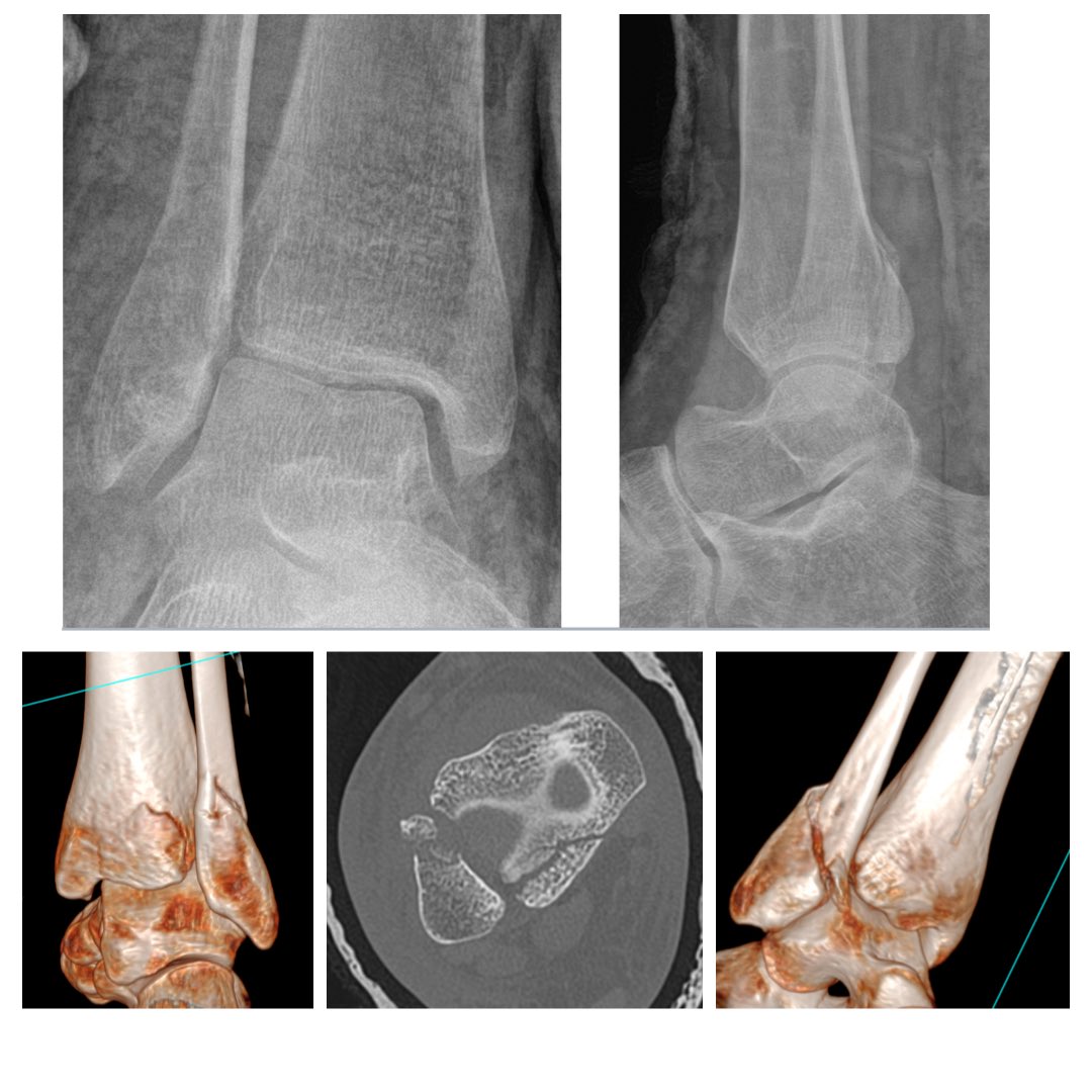 Topics of discussion

1. Cx or sx treatment?

2. If sx, are you fixing the PM fracture?

3. If you do fix PM fracture, are you stressing the sydesmosis or just accepting stability due to the PM fixation?

4. If treating surgical, are you going to treat the joint impaction?