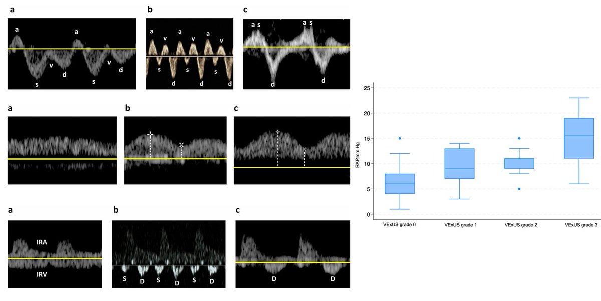 NephroPOCUS (@nephrop) on Twitter photo Correlation between right atrial pressure measured via right heart catheterization and #VExUS, inferior vena cava diameter, and #POCUS-measured jugular venous pressure: a prospective observational study.
Strong work, <a href="/TaweevatA/">Taweevat “Games” Assavapokee</a> and team
#FOAMed #Nephpearls Correlation between right atrial pressure measured via right heart catheterization and #VExUS, inferior vena cava diameter, and #POCUS-measured jugular venous pressure: a prospective observational study.
Strong work, <a href="/TaweevatA/">Taweevat “Games” Assavapokee</a> and team
#FOAMed #Nephpearls