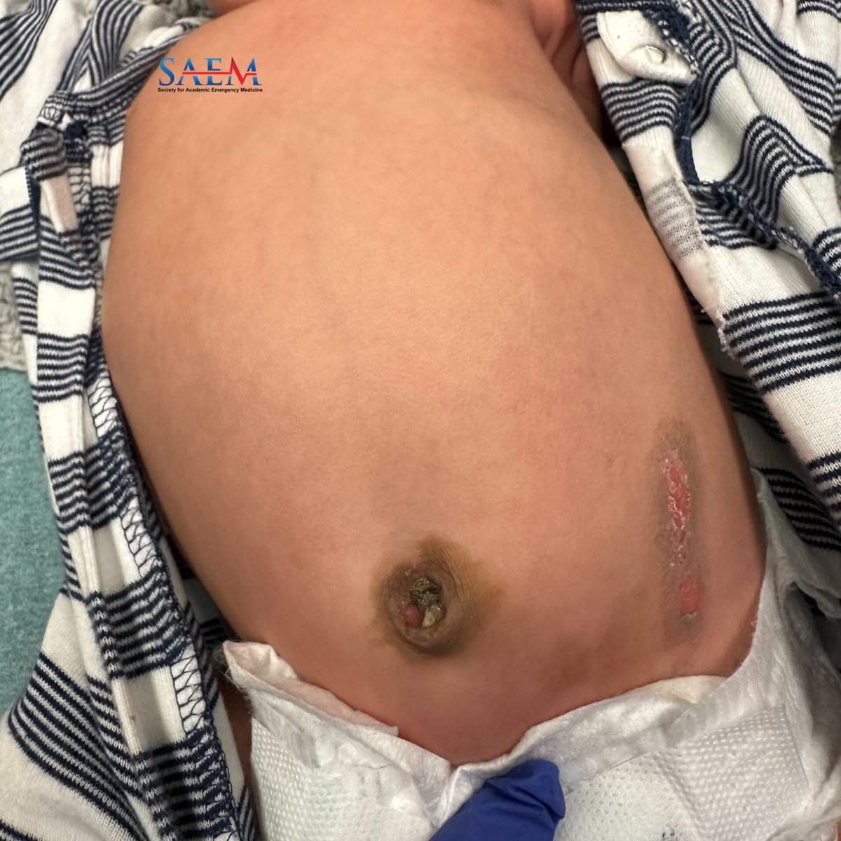 SAEM Clinical Images Series: Infantile Enigma

What or who done it? How could this have happened from routine care?

aliem.com/saem-clinical-…

<a href="/SAEMonline/">SAEM</a>