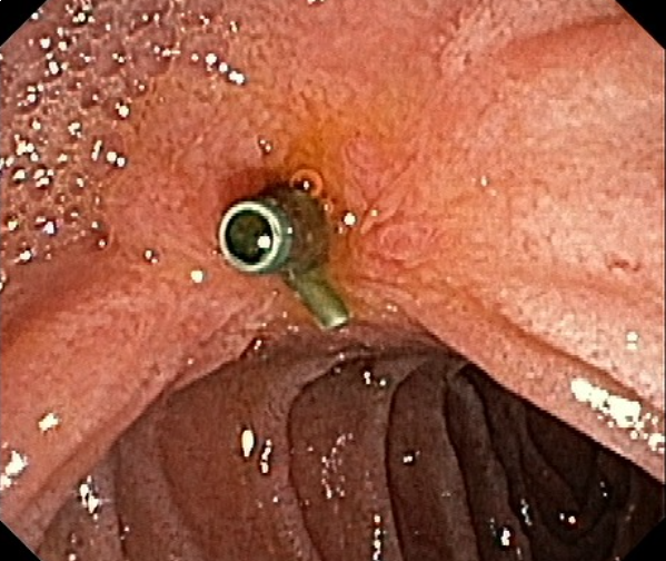 Mid age man with FAP was referred to Baystate for ampullary adenoma, ERCP with ampullectomy was performed 6 months ago...... so satisfying to see the results on last endoscopy #GITwitter