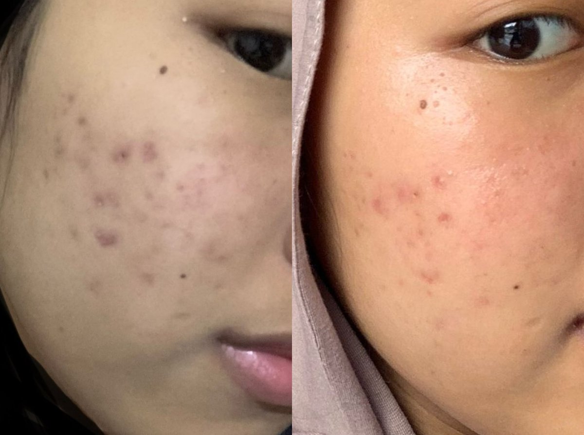 crushnyareece's tweet image. Siapa yang punya problem kulit berjerawat, flek hitam dan udh di tahap gatau mau di obatin pake cara apalagi?!!🥲 sini sinii aku kasih tau