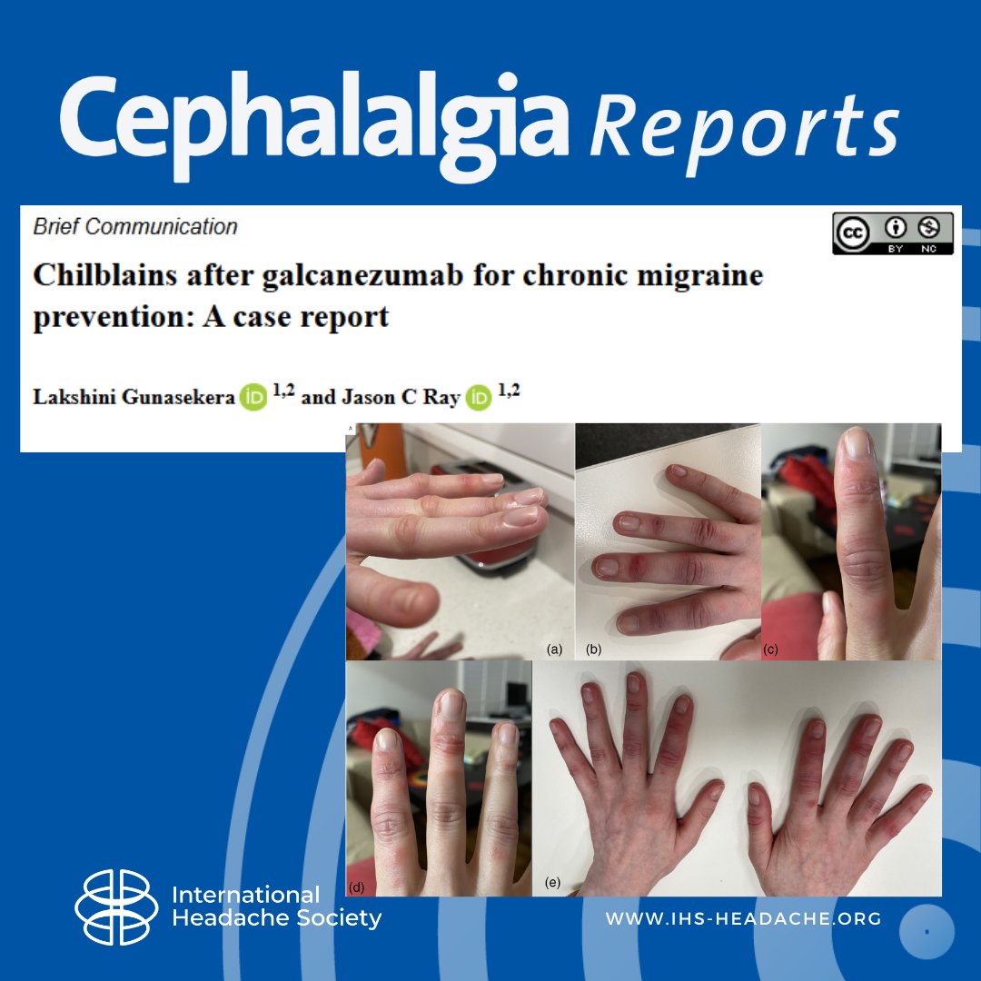 Cephalalgia Reports (@cephreports) on Twitter photo Chilblains may be a spontaneous, monophasic reaction triggered by galcanezumab. Prescribers should be aware of this potential side effect in the post-marketing phase of this medication.
journals.sagepub.com/doi/10.1177/25…
#migraine #headache #brain #pain #neurology #neuroscience
<a href="/dr_jray1/">Jason Ray</a> Chilblains may be a spontaneous, monophasic reaction triggered by galcanezumab. Prescribers should be aware of this potential side effect in the post-marketing phase of this medication.
journals.sagepub.com/doi/10.1177/25…
#migraine #headache #brain #pain #neurology #neuroscience
<a href="/dr_jray1/">Jason Ray</a>