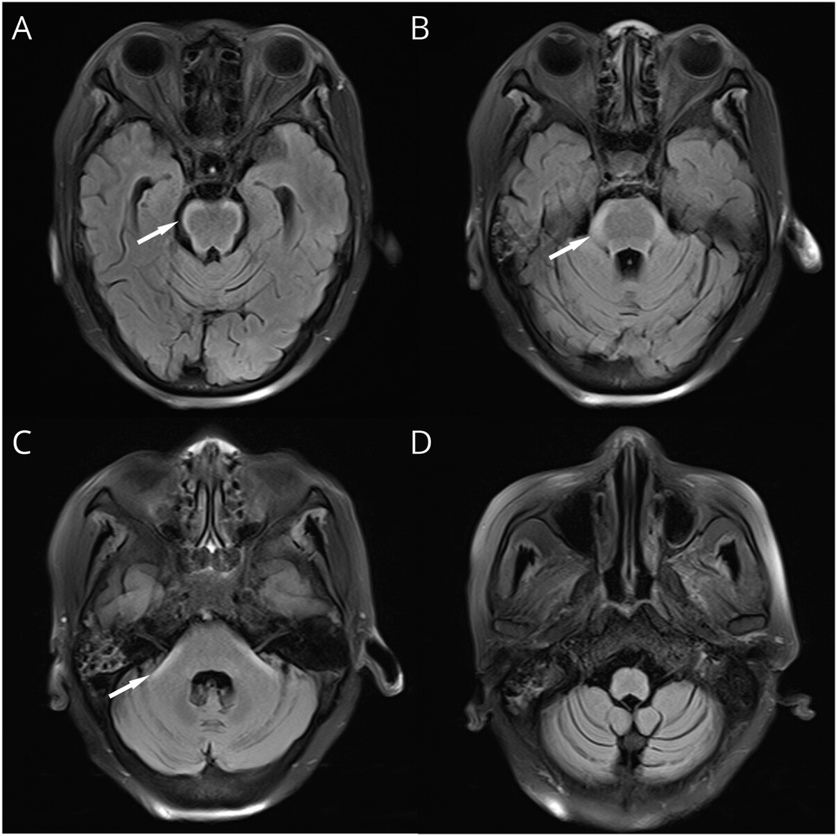NeuroimagingDB's tweet photo. Bloomy rind sign = 脳幹表面のFLAIR高信号

鑑別
✅肺癌髄膜転移
✅Alexander disease
✅GFAP astrocytopathy
✅Adult polyglucosan body disease
✅MOGAD
#Rdiag #RadEd #NeuroRad
画像
https://t.co/jWQDFYsrJK https://t.co/yRvDXFGVeB