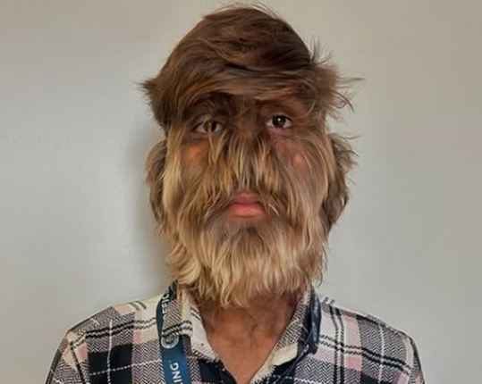 yabaleftonline's tweet photo. Indian boy makes Guinness World Record for hairiest face. 

An 18-year-old in India has made history by securing the Guinness world record for the hairiest face on a man. 

Lalit Patidar has over 95 per cent of his face covered in hair due to a rare condition called hypertrichosis, 'werewolf syndrome'