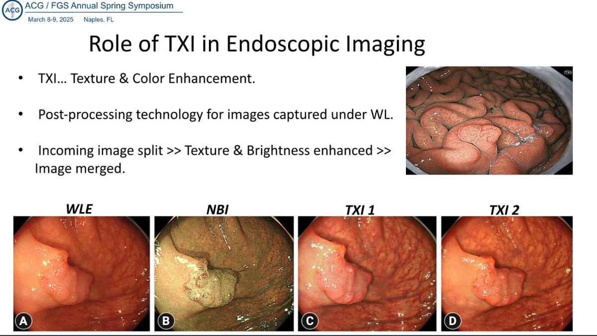 Mariam Naveed, MD (@mn_gimd) on Twitter photo I would be remiss if I didn’t post <a href="/MuzaffarAkbar/">Hafiz Muzaffar Akbar Khan</a> lecture from yesterday as he closed out the conf discussing “Endoscopic Imaging” #FGS2025
When we know our instruments can we use them to their maximum potential!
⭐️NBI: Superficial vessels brown, deeper appear cyan
⭐️ ⬆️ I would be remiss if I didn’t post <a href="/MuzaffarAkbar/">Hafiz Muzaffar Akbar Khan</a> lecture from yesterday as he closed out the conf discussing “Endoscopic Imaging” #FGS2025
When we know our instruments can we use them to their maximum potential!
⭐️NBI: Superficial vessels brown, deeper appear cyan
⭐️ ⬆️