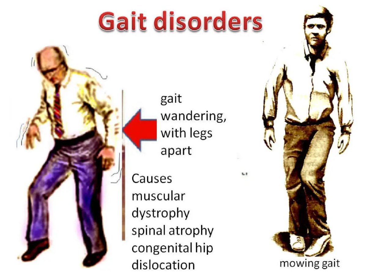 Waddling gait, also known as myopathic gait, is a way of walking. It's caused by muscle weakness in the pelvic girdle, which is a bowl-shaped network of muscles and bones that connects your torso to your hips and legs. It's also responsible for helping you balance.
