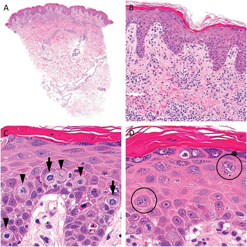 AJDP_Journal's tweet photo. #WhatsNewInDermpath
Histopathologic comparison among drug eruptions induced by enfortumab vedotin, brentuximab vedotin, and taxanes : 22 specimens were reviewed
https://t.co/dGNIeoU6ae https://t.co/RBuX4BZQ1T