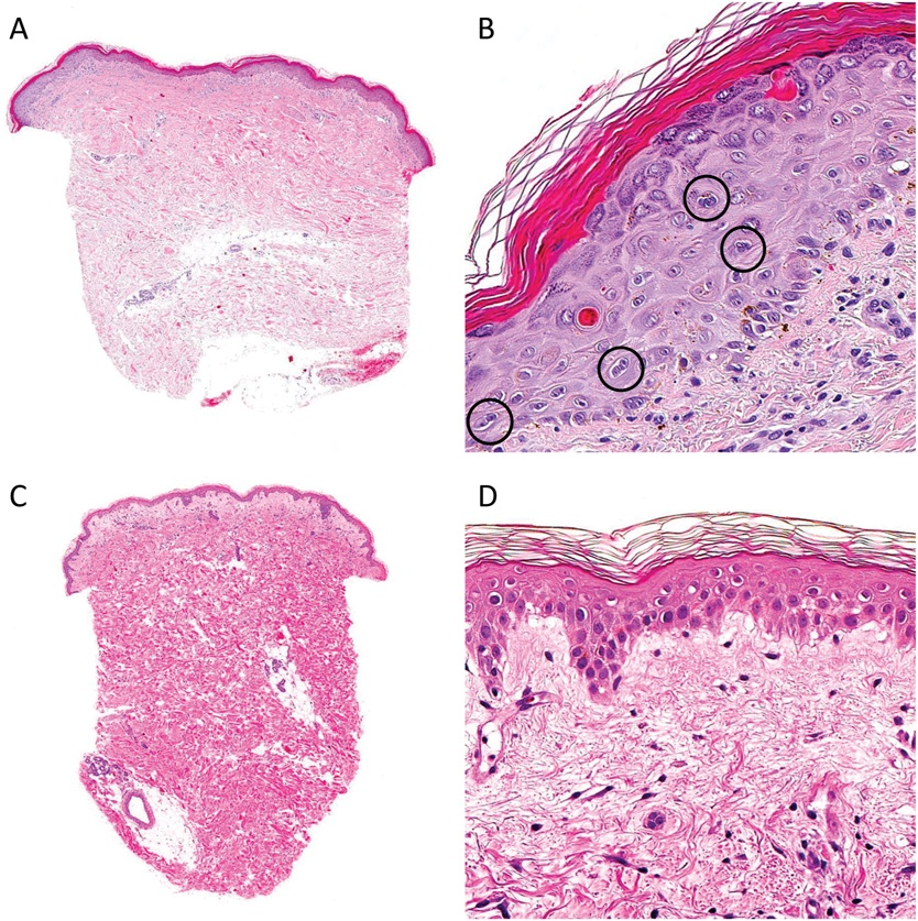 AJDP_Journal's tweet photo. #WhatsNewInDermpath
Histopathologic comparison among drug eruptions induced by enfortumab vedotin, brentuximab vedotin, and taxanes : 22 specimens were reviewed
https://t.co/dGNIeoU6ae https://t.co/RBuX4BZQ1T