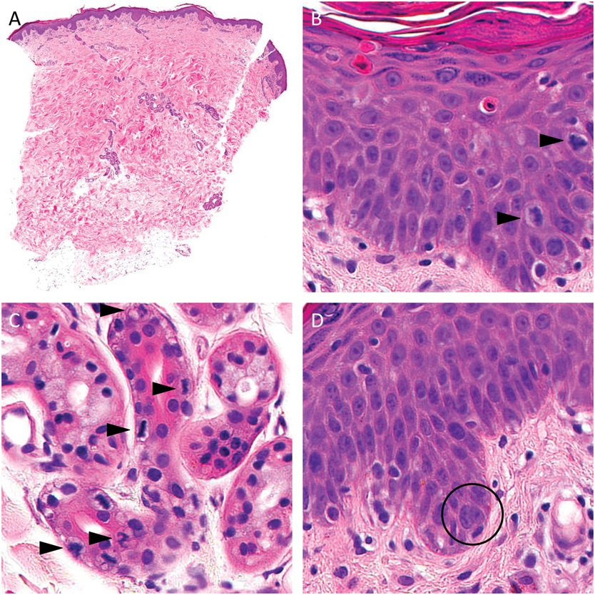 AJDP_Journal's tweet photo. #WhatsNewInDermpath
Histopathologic comparison among drug eruptions induced by enfortumab vedotin, brentuximab vedotin, and taxanes : 22 specimens were reviewed
https://t.co/dGNIeoU6ae https://t.co/RBuX4BZQ1T