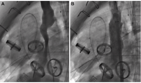 New Case Report in JACC

A case from Jahanshad et al. at Morgan Stanley Children’s Hospital highlights the SynCardia TAH as a bridge to transplant in a 15-year-old with end-stage heart failure.

See jacc.org/doi/abs/10.101… for the complete case report.

#SynCardia