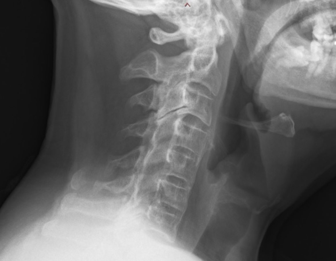 Nuevos datos sobre la artritis psoriásica axial en esta serie de casi 1000 pacientes

🔸25.8% prevalencia
🔸Menos artritis
🔸Más HLA-B27, entesitis, EII
🔸32% afectación sólo vertebral

Acceso cerrado 🔒 pubmed.ncbi.nlm.nih.gov/40059325/
