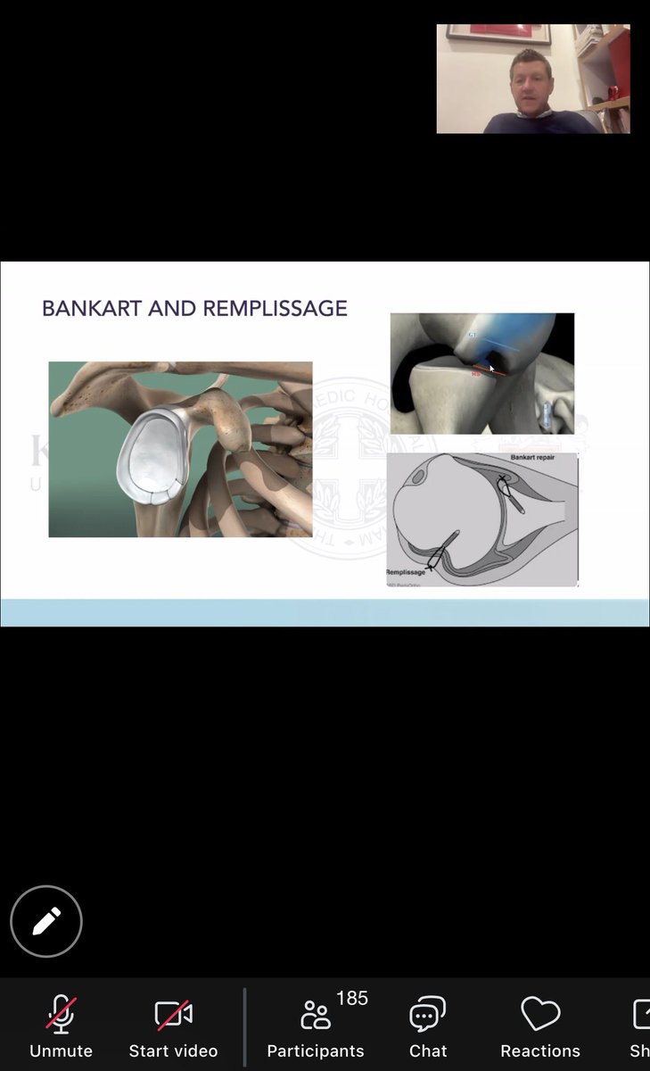 An insightful zoom tonight with Prof Martyn Snow,who gave a well attended clinical talk on knee &amp; shoulder instability.
Thank you also to our 180+ GP, Physio&amp; clinical attendees
For the remainder of sessions until Easter see: 

bhamknee-shoulder.co.uk/news

#MedEd #shoulders #knees