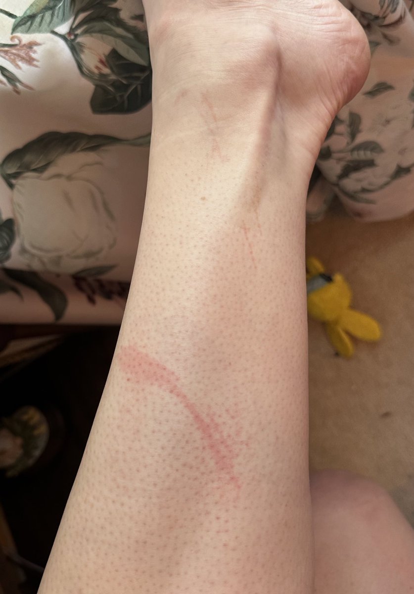 ohmyeq's tweet photo. *potential content warning if hives/rashes freak you out- flagged the worst ones*
My skin will now be referred to as ‘epiderbitch’ since it wants to be so damn dramatic 

No broken skin on any of these, just simply from movement as simple as putting on clothes and making food https://t.co/mAHuAlJe0c