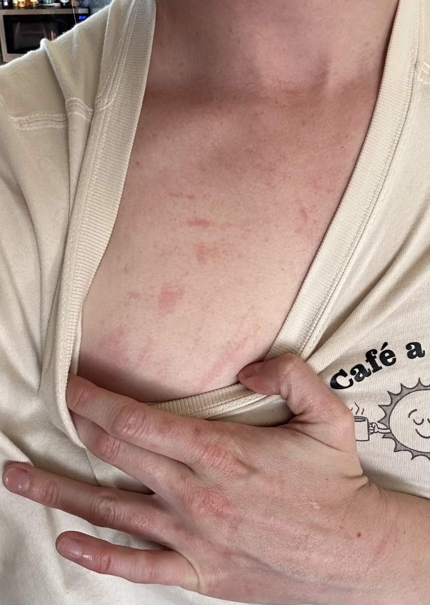 ohmyeq's tweet photo. *potential content warning if hives/rashes freak you out- flagged the worst ones*
My skin will now be referred to as ‘epiderbitch’ since it wants to be so damn dramatic 

No broken skin on any of these, just simply from movement as simple as putting on clothes and making food https://t.co/mAHuAlJe0c