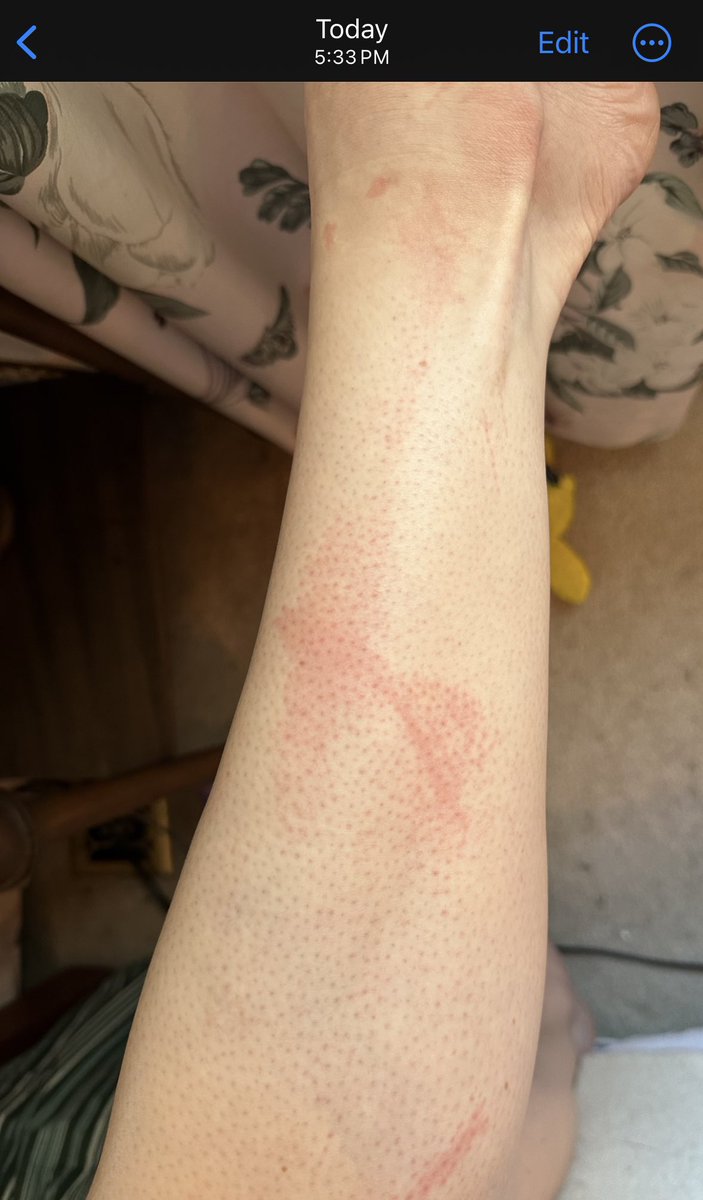 ohmyeq's tweet photo. The one got worse in case anyone is fascinated by how much it likes to flare up in a short amount of time cuz I know I sure am lmao https://t.co/FHn4cvgVVB
