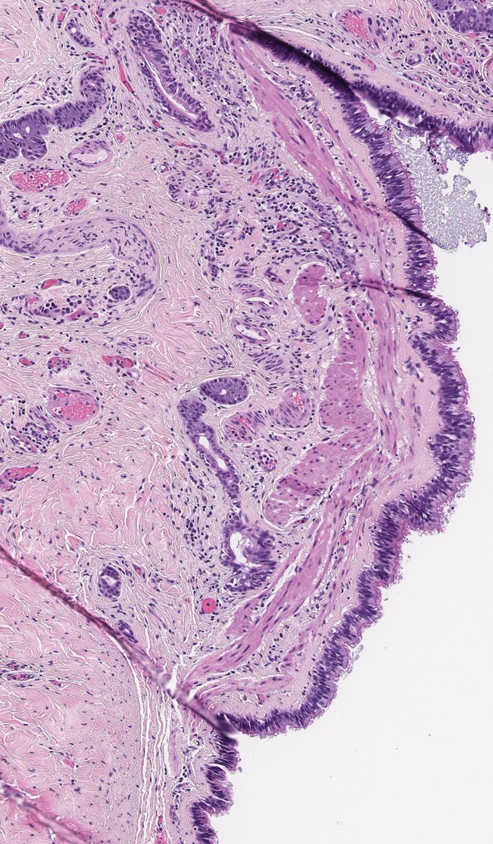 DrCycloPath's tweet image. Baby girl with a paratracheal cyst arising from a:
A) malformation of the tracheobronchial tree
B) abnormal sequestration of ectoderm
C) failure of branchial cleft obliteration
D) failure of thyroglossal duct obliteration 
#PediPath #PathTwitter #Pathology #BSTPath