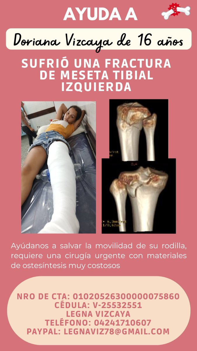 eldiario's tweet photo. #ServicioPúblico | Doriana Vizcaya, de 16 años de edad, sufrió una fractura de meseta tibial izquierda que requiere cirugía urgente.

Los gastos médicos ascienden a 1.339 dólares. Sus familiares solicitan cualquier ayuda para costear la operación. 

Para colaborar con Doriana 👇.

Nro de cuenta: 01020526300000075860
Cédula: V-25532551
Teléfono: 04241710607
Banco de Venezuela

PayPal: legnaviz78@gmail.com