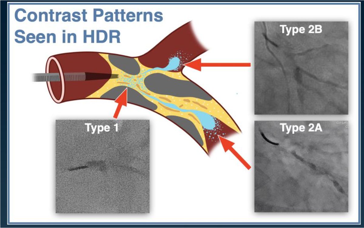 Michael Megaly (@michaelmegalymd) on Twitter photo This year I am late in #my_4_slides on my most important takeaways from #CTO2025
Lots of great stuff and I will start with the intriguing #CTO #PCI techniques I will try in 2025.
1-HDR presentation by <a href="/realarainmd/">Salman Arain</a>
He explains it perfectly, his cases on X are enjoyable.
In a This year I am late in #my_4_slides on my most important takeaways from #CTO2025
Lots of great stuff and I will start with the intriguing #CTO #PCI techniques I will try in 2025.
1-HDR presentation by <a href="/realarainmd/">Salman Arain</a>
He explains it perfectly, his cases on X are enjoyable.
In a