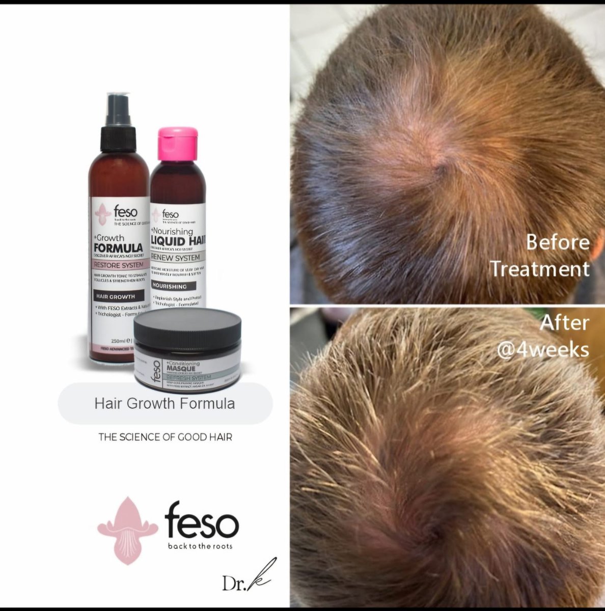 #hairstyles &amp; #HairGoals Feso is the best when it comes to taking care of your receding hairline.

Get Feso hair products available in Zimbabwe&amp;South Africa 

Whatsapp+27 78 389 3757

fesoafrica.com 
<a href="/kudamupawoseman/">Kuda mupawose</a>