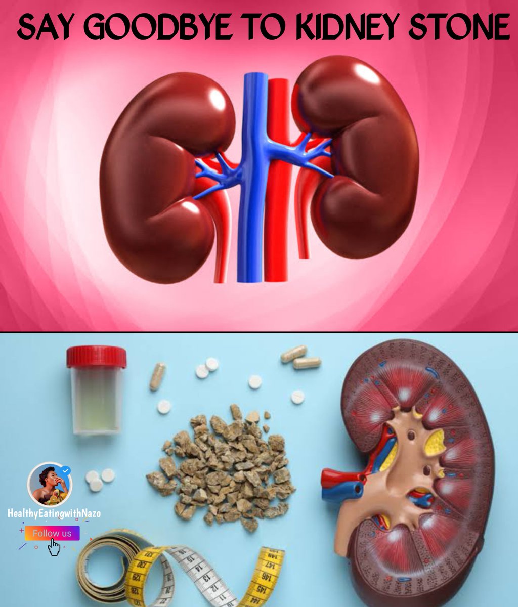 EATINGWITHNAZO's tweet photo. KIDNEY STONE ‼️‼️‼️

SAY GOODBYE TO KIDNEY STONE 

🔑7 PROVEN STRATEGIES/STEPS TO PASS WITH FLYING COLORS 

A DETAILED THREAD 👇 https://t.co/LD0v1wCLTh