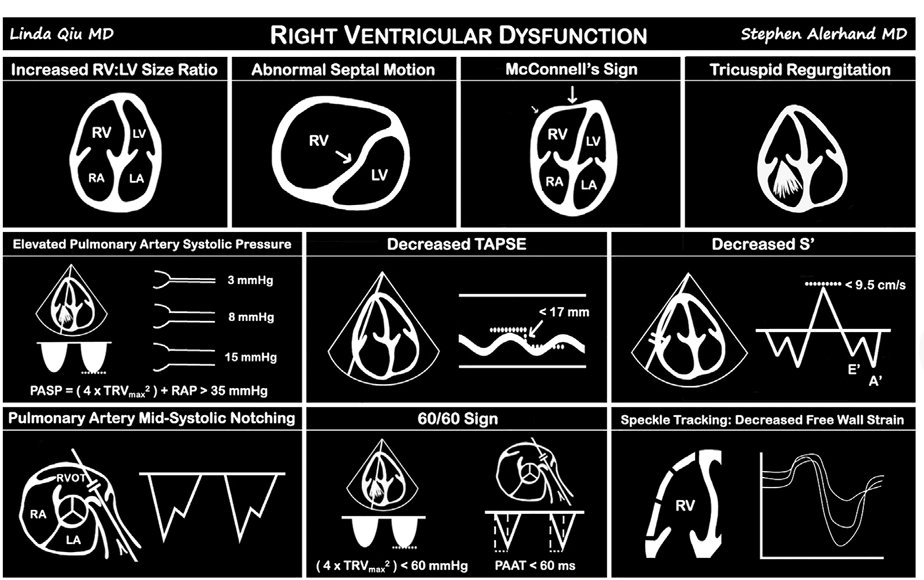 LeslieMegom's tweet photo. 🫀Ecocardiografia en áreas críticas ⚠️💥🩺
📈 Evaluación: Disfunción sistólica y diastólica ventricular izquierda, derrame pericárdico,  tamponamiento cardíaco ,  disfunción ventricular derecha aguda y crónica, la disfunción valvular y la actividad cardíaca en el paro cardíaco.🫀⚠️
🗒️☕:
🫀💥Las pautas de la ASE y el ACEP recomiendan el uso de PoCUS solo en la AESP o asistolia, no recomiendan su uso en ritmo desfibrilable identificación de la fibrilación ventricular (FV) o la taquicardia ventricular sin pulso (TVSP) y la reanudación de las compresiones torácicas. 
💥Un estudio prospectivo descubrió que los controles de pulso mediante compresión de la arteria carótida con sonda de ultrasonido fueron más rápidos en comparación con la palpación manual (1,62 segundos frente a 3,5 segundos respectivamente), y el tiempo para determinar el ROSC se acortó significativamente a 0,44 veces el tiempo de palpación manual (P <0,001).
🫀💥Protocolo CAUSE.
identificar 4 causas potencialmente reversibles de PCR: un ventrículo derecho dilatado en la embolia pulmonar, líquido alrededor del corazón en taponamiento pericárdico, ventrículos colapsados en hipovolemia y ausencia de deslizamiento pulmonar en neumotórax a tensión, vena cava inferior, aorta abdominal para evaluar el aneurisma como causa de hipovolemia  💥Es poco probable que la detección de patologías como anomalías en el movimiento de la pared o miocardiopatía hipertrófica afecte el tratamiento durante la RCP, pero debe identificarse después del RCE.
💥sugiere la ventana subxifoidea para mantener la monitorización continua durante toda la reanimación o utilizar la ventana de mayor preferencia o experiencia del operador, cambiándola cada 3 segundos si no se logra una imagen satisfactoria. 
💥CLUE cardiopulmonary limited ultrasound examination: Evalúa: 
Disfunción sistólica del VI, Auricula izquierda , VCI ,Artefactos de cola de cometa en el pulmón.
🫀Protocolo FEER 
 primer algoritmo que incorpora la ecografía cardíaca en la RCP,  se recomienda implementar después de 5 ciclos de RCP de alta calidad. FEER se realiza sólo durante el chequeo de pulso de 10 segundos y posee un orden estructurado, cambiando de ventana después de cada ciclo 
👇🏽👇🏽👇🏽👇🏽👇🏽
https://t.co/dxNcV7jdfM
🔐https://t.co/3ATGPot4rc