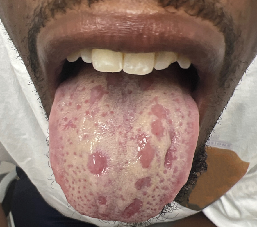 A 29-y-o ♂️with well-controlled HIV infection, a 4-week history of painful ulcers on the scrotum: a 1-week of a painful, whitish discoloration on his tongue (smooth, pink, guttate macules within a white coating).
1/2

DOI: 10.1056/NEJMicm2411077
#infectious #Health