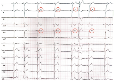 EP Lab Digest (@eplabdigest) on Twitter photo 🧬💓 Genetic Testing & Early-Onset Atrial Fibrillation: When Is It Necessary? 💓🧬
Could genetics hold the key to better AFib management? Dr. Knight explores when genetic testing is recommended for early-onset #AF. 🔍
📖 Read more: hubs.ly/Q039NvDZ0 <a href="/DrBradleyKnight/">Bradley Knight</a> 🧬💓 Genetic Testing & Early-Onset Atrial Fibrillation: When Is It Necessary? 💓🧬
Could genetics hold the key to better AFib management? Dr. Knight explores when genetic testing is recommended for early-onset #AF. 🔍
📖 Read more: hubs.ly/Q039NvDZ0 <a href="/DrBradleyKnight/">Bradley Knight</a>