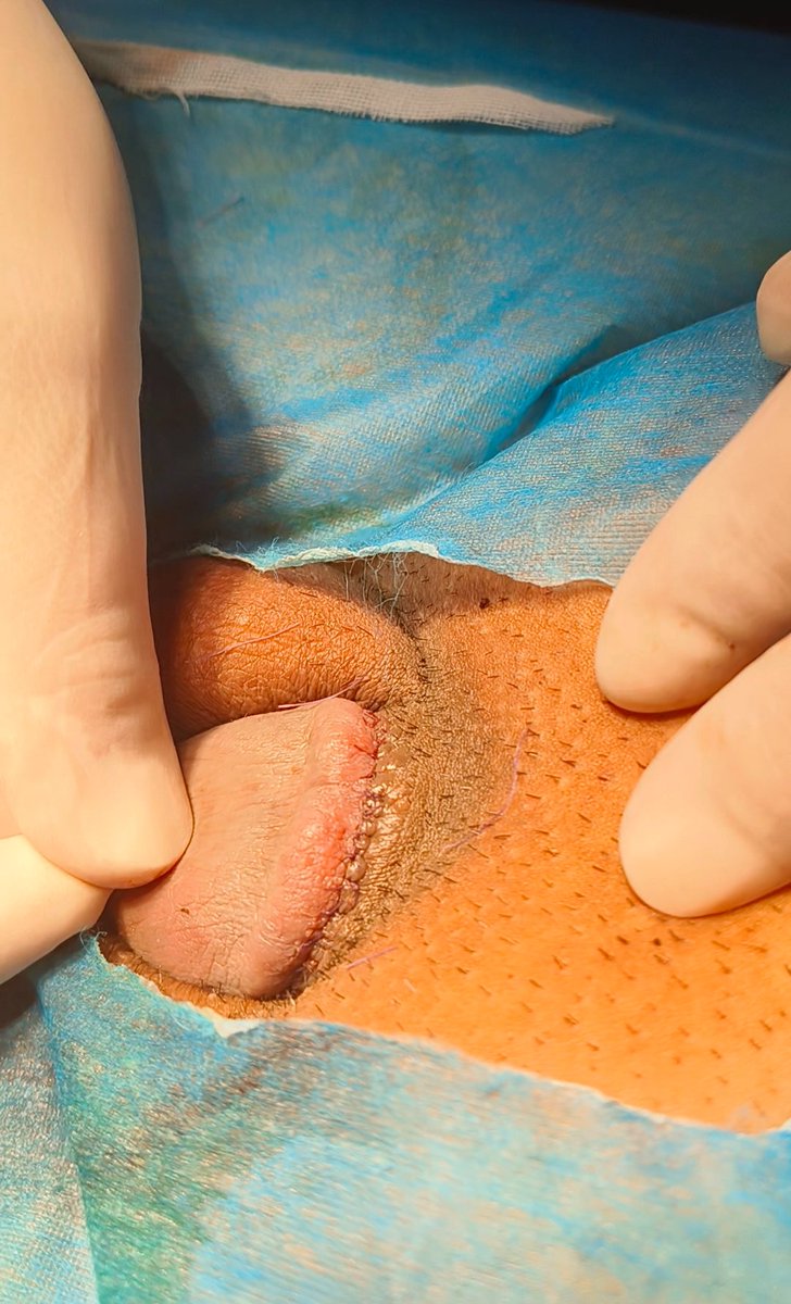 阴茎缩短术Penile skin castration tweet media