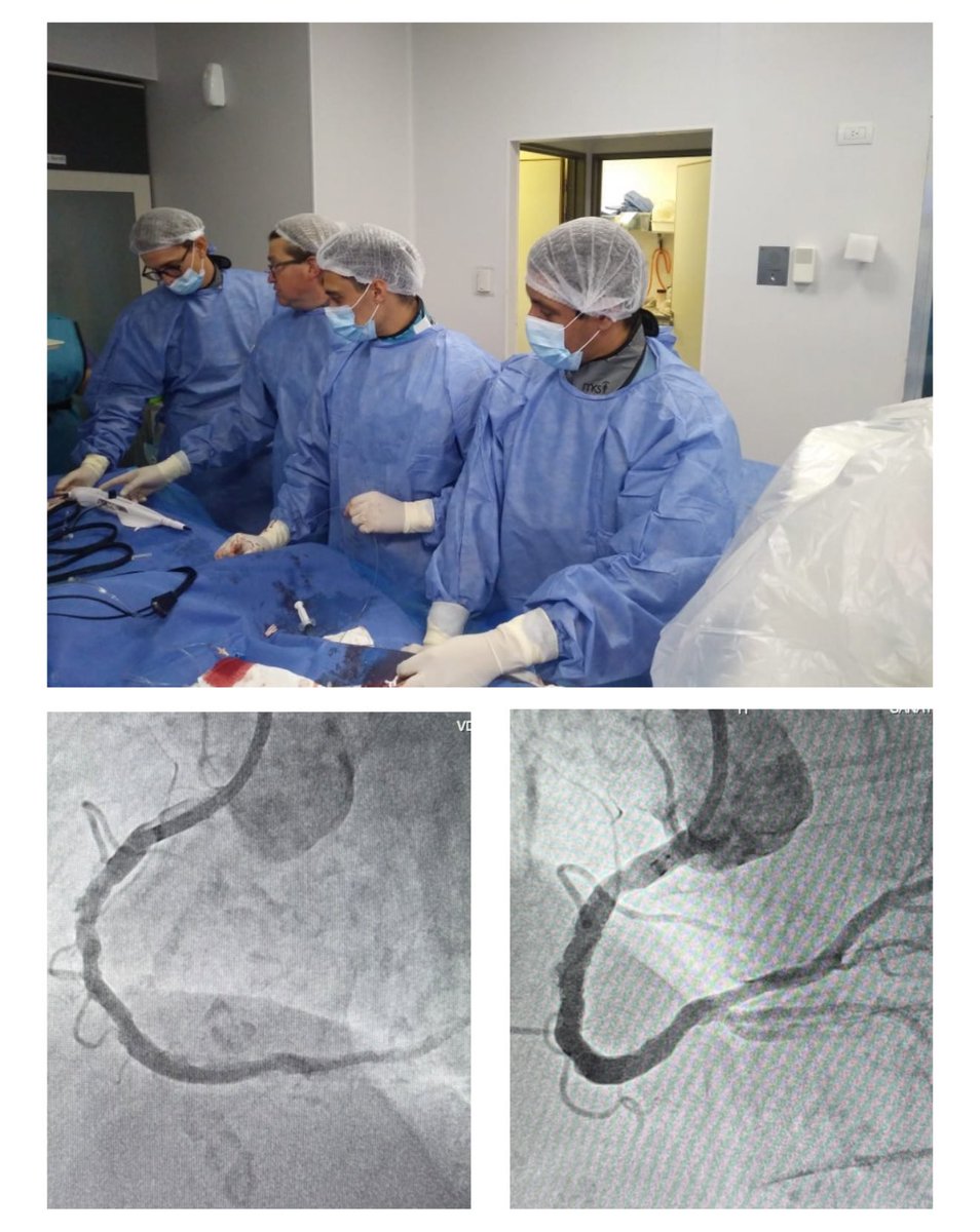Nicommarietti's tweet image. ATC a CD con sistema de aterectomía rotacional “Rotablator” e infusión de aminofilina profilactica. 

#bostonscientific #rotablator #angioplastia #hemodinamia #cordoba