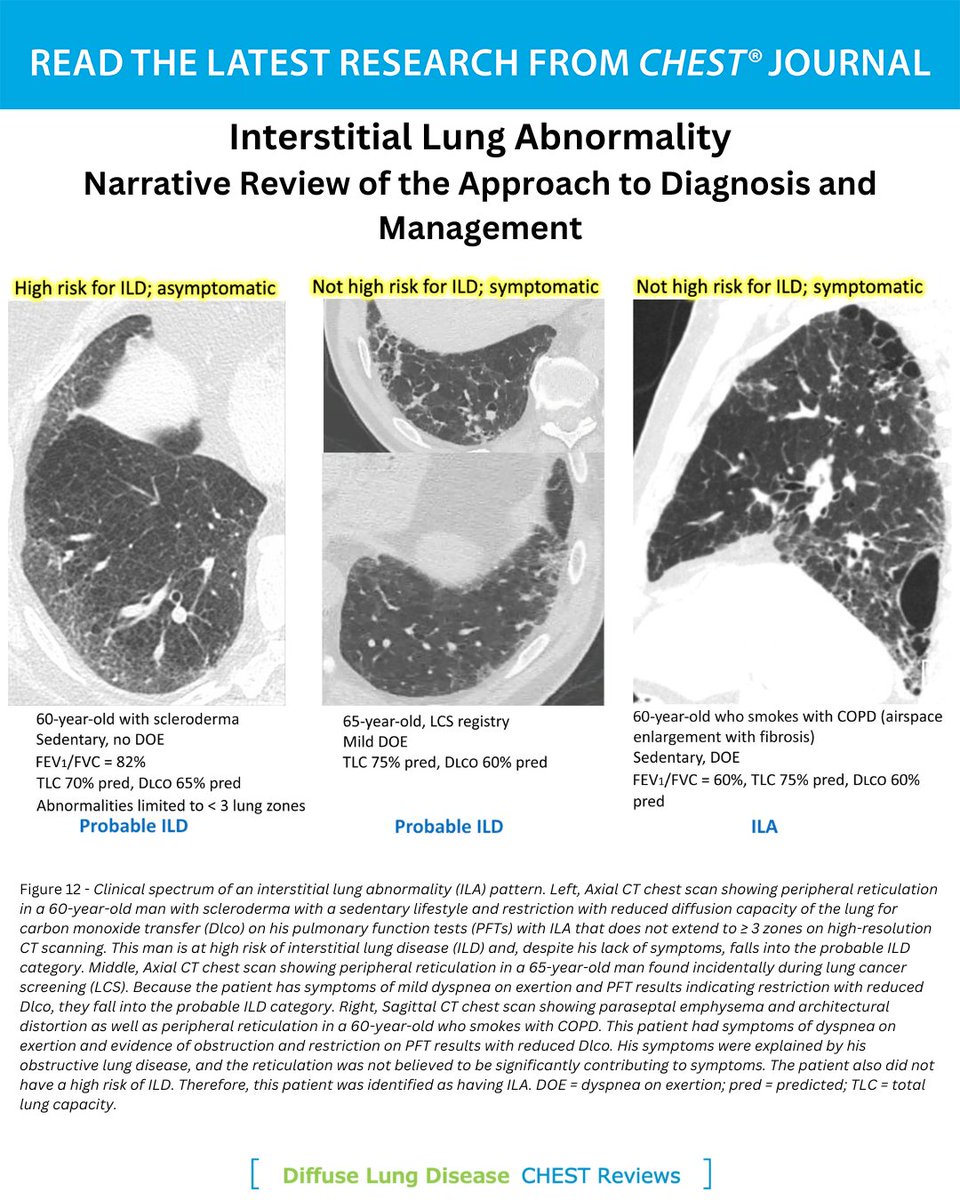 A new #CHESTReview explores a proposed algorithmic approach to the identification and management of patients with interstitial lung abnormalities. Read more in the March issue of the journal CHEST®: hubs.la/Q03bbTwf0
#MedEd #JournalCHEST #ILD