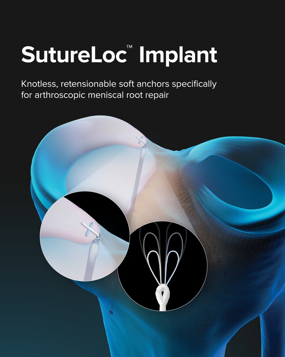 ArthrexMedEd's tweet image. With a focus on precise instrumentation and a drive for constant innovation, #Arthrex offers knee products and techniques designed to optimize the operative experience and deliver positive patient outcomes. Get hands-on experience with our newest knee solutions at the #AAOS 2025…