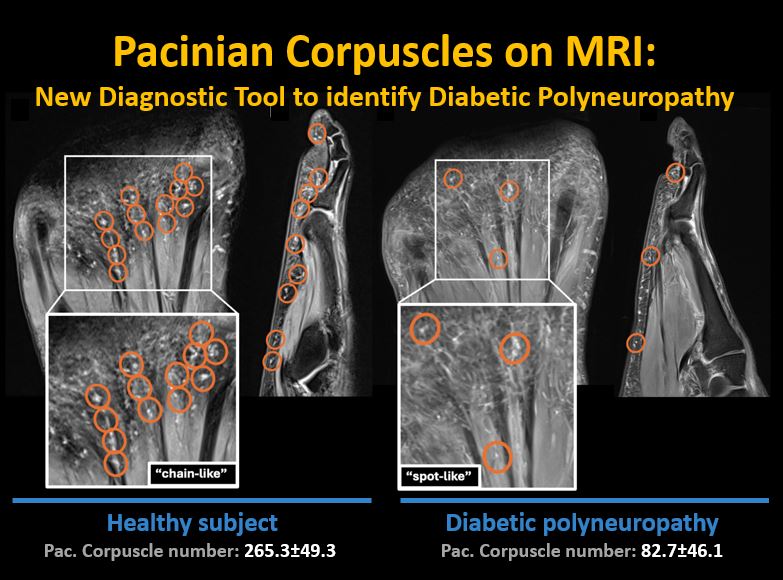 SutterBalgrist's tweet image. New #MRI study about #PacinianCorpuscles in diabetic patients with polyneuropathy: Read it for free 👉insightsimaging.springeropen.com/articles/10.11…
🔵Reduced number & altered pattern of corpuscles may predict diabetic polyneuropathy
@derbalgrist @InsightsImaging @sophiasamira92 #MSKrad #OpenAccess