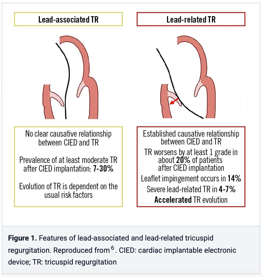 EuroIntervention (@eurointerventio) on Twitter photo The rise of CIED-related TR demands awareness, better screening, and refined interventional strategies.
A must-read perspective by M. Andreas, Philipp E. Bartko, <a href="/AndreasZirlik/">Prof. Dr. Andreas Zirlik</a> et al.
📖 ow.ly/7UQb50VfCHs
#CIED #TricuspidRegurgitation #StructuralHeart #TTVR #TTEER The rise of CIED-related TR demands awareness, better screening, and refined interventional strategies.
A must-read perspective by M. Andreas, Philipp E. Bartko, <a href="/AndreasZirlik/">Prof. Dr. Andreas Zirlik</a> et al.
📖 ow.ly/7UQb50VfCHs
#CIED #TricuspidRegurgitation #StructuralHeart #TTVR #TTEER